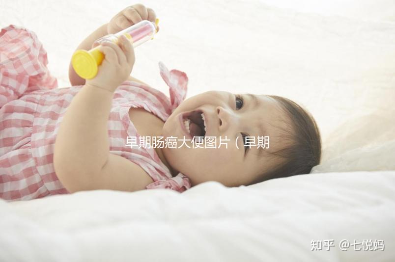 早期腸癌大便圖片(早期腸癌大便圖片 前兆)