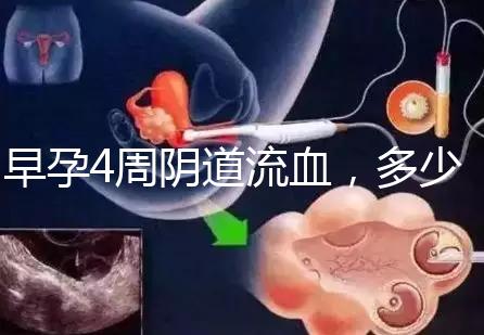 早孕4周陰道流血，多少天檢查血hcg或B超更穩妥？