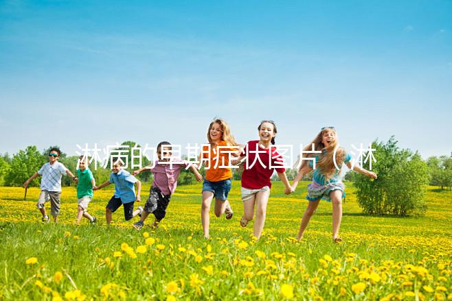 淋病的早期癥狀圖片（淋病有什么癥狀圖片）